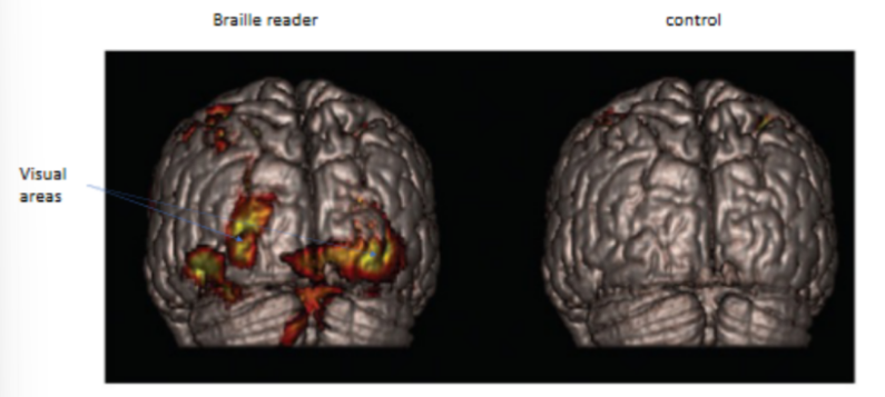 <p>experienced Braille readers can read ~<u>100</u> words/minutes, compared to <u>250-300</u> words/minute for visual reading</p><p>_</p><p>experienced Braille readers show large responses in occipital lobe while reading Braille, compared to control/sighted subjects </p><ul><li><p><s>^ the cortical region for fingertips and face are adjacent, so the perception of viewing words at the face is “taken over” by the cortical region of the fingertips</s> ← NO b/c occipital lobe is part of V1, so is not explained by S1 of crossed out info</p></li></ul><p></p>