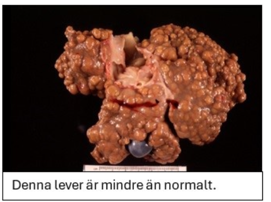 <p><strong>Kombinera det makroskopiska utseenden hos respektive lever (A-D) med trolig diagnos.</strong></p><p class="p1"><strong>Dra rätt alternativ till ”diagnos” för respektive bild. Endast ETT alternativ per</strong></p><p class="p1"><strong>makroskopiskt utseende. (2p)</strong></p>