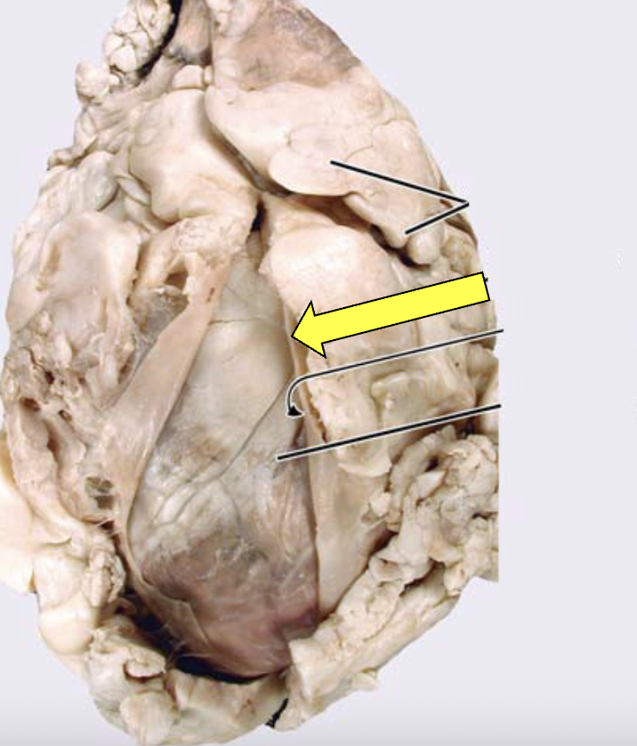 <p>fibrous pericardium </p>