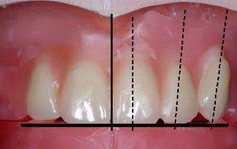 <p>central incisor : </p><ul><li><p>incisal edge contacts the horizontal plane</p></li><li><p>long axis parallel to sagittal plane</p></li><li><p>frontal inclination <strong>5-8<sup>o</sup></strong></p></li><li><p>overlap with lover incisors should be 1</p></li></ul><p>lateral incisor : </p><ul><li><p>0.7mm-1mm above the horizontal plane</p></li><li><p>sagittal inclination <strong>10-20<sup>o</sup> </strong></p></li><li><p>frontal inclination<strong> 8<sup>o</sup></strong></p></li></ul><p>canine : </p><ul><li><p>cusp in contact with plane</p></li><li><p>sagittal inclination <strong>7-10<sup>o</sup></strong></p></li><li><p>axial rotation of the crown so that when viewed from the front only the mesial part is visible</p></li></ul><p></p>