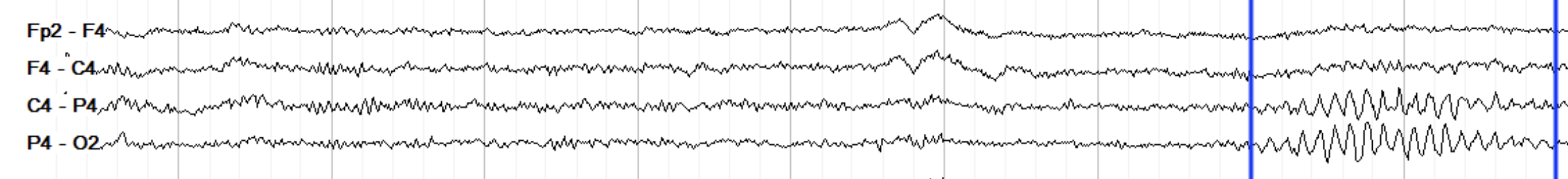 <p>12-14hz from reticular hypothalamuys </p>