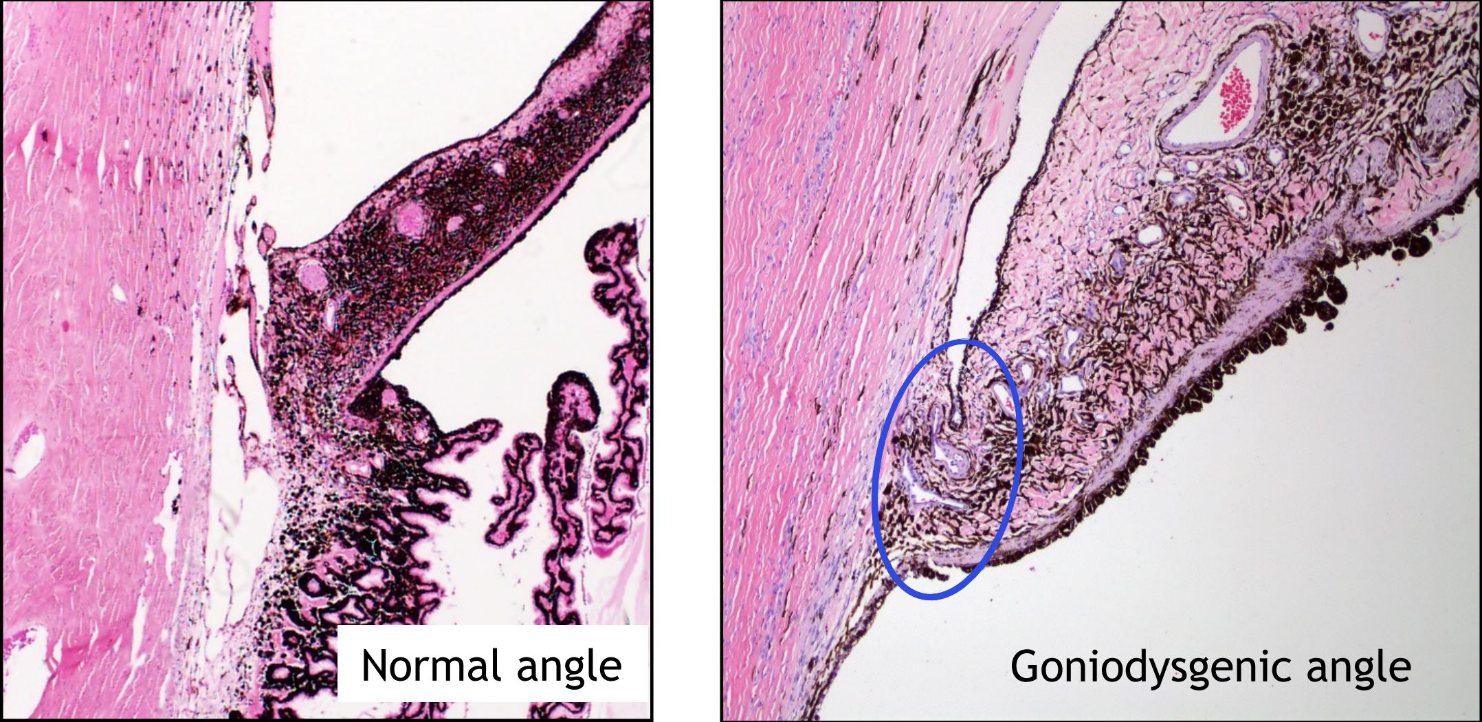 <ul><li><p>congenital abnormality — malformation of the iridocorneal angle structures</p></li><li><p>predisposes animal to development of glaucoma at any age</p></li></ul><p></p>