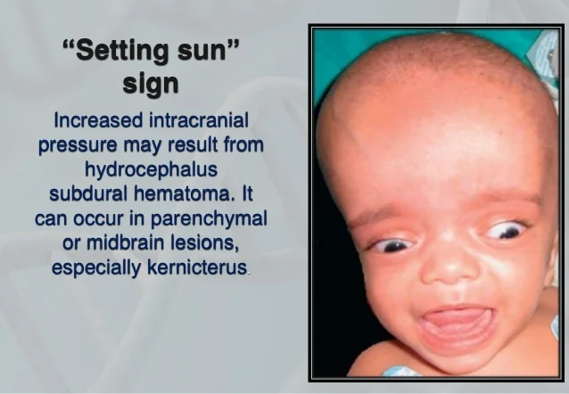 <ol><li><p><span style="color: rgb(255, 134, 134);"><strong>bulging fontanel</strong></span> (<span data-name="arrow_up" data-type="emoji">⬆</span>ICP)</p></li><li><p><span style="color: rgb(236, 195, 26);"><strong>sun setting eyes</strong></span> (driven downward bilaterally—usually in <span style="color: rgb(169, 141, 23);">hydrocephalus</span>)</p></li><li><p><span style="color: rgb(26, 157, 118);"><strong>separation of cranial sutures</strong></span></p></li><li><p><span style="color: rgb(177, 129, 236);"><strong>increased sleep</strong></span></p></li><li><p><span style="color: rgb(41, 57, 221);"><strong>poor feeding</strong></span></p></li></ol><p></p>