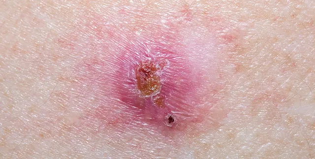 <p>What is this skin condition?</p>