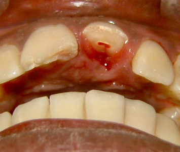 <p>-enamel-dentin-pulp</p><p>-apply concept 1: if root mature then remove the pulp/RCT, if root immature then preserve radicular pulp tissue</p>