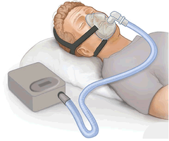 <p>a sleep disorder characterized by temporary cessations of breathing during sleep and repeated momentary awakenings.</p>