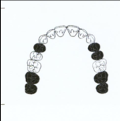 <p>What kennedy classification? (black are missing teeth, all missing teeth are replaced by partial denture except 3rd molar which is not replaced)</p>