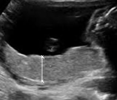 <ul><li><p>measure in AP dimension</p></li><li><p>thickest portion <span style="color: red;">perpendicular to uterine wall</span></p></li><li><p><span style="color: red;">DO NOT include uterine wall in measurement</span></p></li><li><p>typically measure after 23 weeks</p></li></ul><p></p>