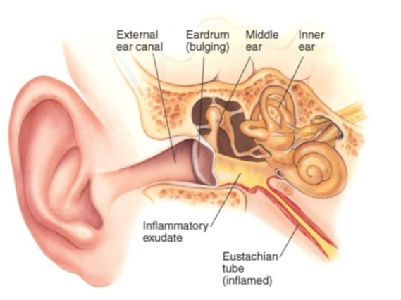 <p>Acute otitis media—middle ear infection</p><p>Bacteria from URT can gain entry to middle ear by<strong> Eustachian</strong></p><p><strong>(auditory) tube.</strong></p><p><span><strong>Bacteria from the upper respiratory tract reach the middle ear by traveling through the <em>Eustachian tube</em>, which connects the nasopharynx to the middle ear. When this tube becomes blocked or inflamed, pathogens can move upward and cause otitis media.</strong></span></p><p></p>