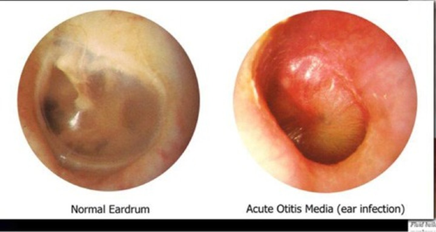 <p>Inflammation of middle ear</p>