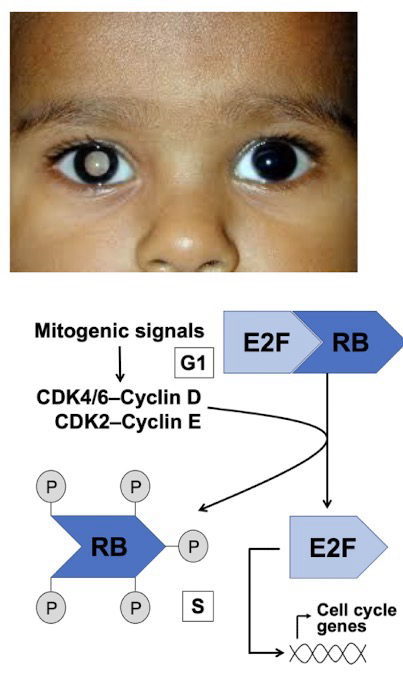 <p>Mutation in RB1 gene inactivates <strong>retinoblastoma protein (pRb)</strong> function/production, a key regulator of <strong>G1/S checkpoint</strong></p><p>pRb typically inhibits <strong>E2F</strong> transcription, preventing early entry to the <strong>S phase</strong></p><p>This loss of cell cycle control results in excessive proliferation and tumor formation (Because cells no longer stops to fix DNA damage)</p><p><strong>Two-hit hypothesis</strong>: A defective allele is inherited and the second is lost through somatic mutation</p>