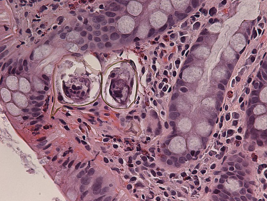<p>Diarrhée </p><p>1) diagnostic </p><p>2) histologie </p>