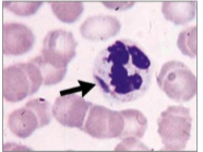 <p>Large granules in cytoplasm of neutrophils</p><p></p>