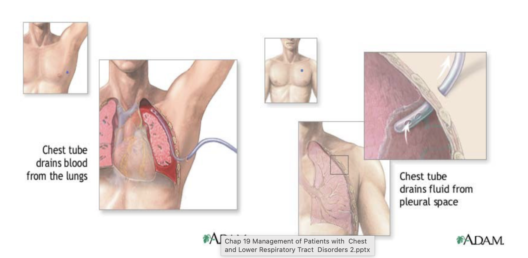 <ul><li><p><span style="color: rgb(0, 0, 0);">Purpose: remove air and/or fluid from the pleural space and restore<br>negative intrapleural pressure, allowing the lung to re-expand</span></p></li><li><p>Indications: pneumothorax, hemothorax, pleural effusion, empyema, and<br>after thoracic surgery to restore pressure </p></li><li><p><span style="color: rgb(0, 0, 0);">high placement if air in the lungs</span></p></li><li><p><span style="color: rgb(0, 0, 0);">low placement if fluid/blood is in the lungs </span></p></li></ul><p></p>