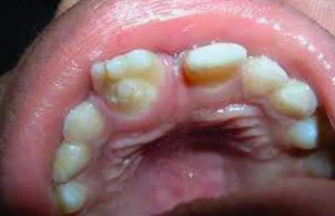 <p>approaching inward</p><p>this creates the appearance of a <span style="color: red;">tooth within a tooth</span></p><p>results from invagination of the<span style="color: red;"> inner enamel epithelium</span></p><ul><li><p>most <span style="color: red;">commonly affected</span> tooth:</p><ul><li><p><span style="color: red;">maxillary lateral incisors</span></p></li></ul></li><li><p>clinical significance:</p><ul><li><p><span style="color: red;">high risk of dental caries and pulpal involvement</span> bc the invaginated portion on the lingual surface may communicate with the oral environment</p></li></ul></li><li><p>management:</p><ul><li><p>early diagnosis</p></li><li><p><span style="color: red;">prompt preventive treatment</span>, including:</p><ul><li><p><span style="color: red;">pit and fissure sealants</span></p></li><li><p><span style="color: red;">restorations</span> if necessary</p></li></ul></li></ul></li></ul><p></p>