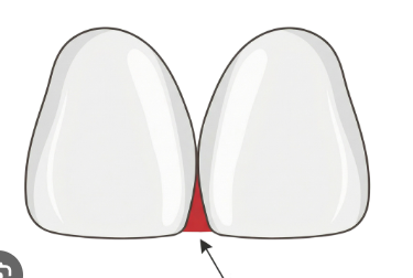<p>Space between teeth — begins at contact area and widens down towards gingiva</p><ul><li><p>Filled by interdental papillae</p></li></ul><p></p>