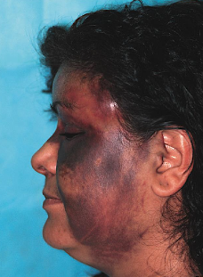<p><strong>aka:</strong> bruise</p><p>indicates that some amount of tissue <span style="color: red;">disruption has occurred within the tissues</span></p><p>results in <span style="color: red;">subcutaneous or submucosal hemorrhage</span> without a break in the soft tissue surface</p><ul><li><p>causes:</p><ul><li><p>by a blunt object</p></li></ul></li><li><p><strong>key features:</strong></p><ul><li><p><span style="color: red;">bruise</span></p></li><li><p><span style="color: red;">tissue disruption</span></p></li><li><p><span style="color: red;">no surface break</span></p></li></ul></li><li><p>tx:</p><ul><li><p><span style="color: red;">no treatment</span> is required</p></li><li><p>in the<strong> early stages:</strong></p><ul><li><p><span style="color: red;">application of ice</span></p></li><li><p><span style="color: red;">pressure dressings</span></p></li></ul></li></ul></li></ul><p></p>