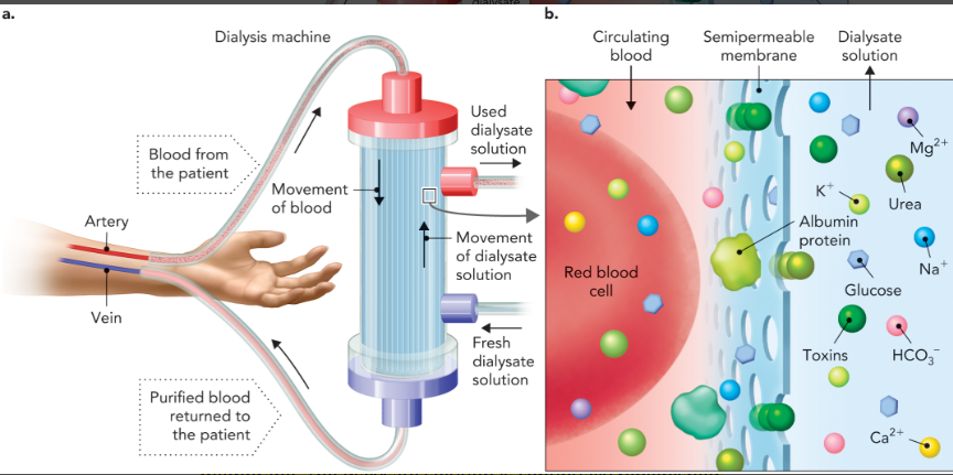 <p>procedure used by patients with kidney disease to remove waste products from the blood using high diffusion rates across a semi-permeable membrane </p>