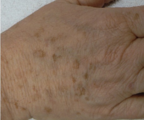 <p>Melanoma in Situ</p><p>MIMIC: Solar Lentigo (benign skin lesion)</p><ul><li><p>light brown, uniform color BUT may be asymmetric</p></li></ul><p></p>