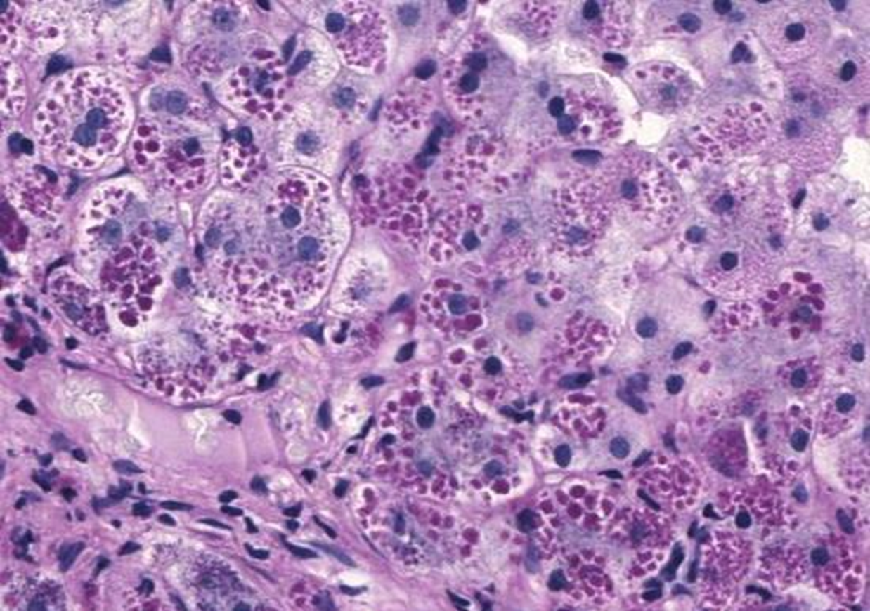 <p>PAS stain after diastase digestion</p>
