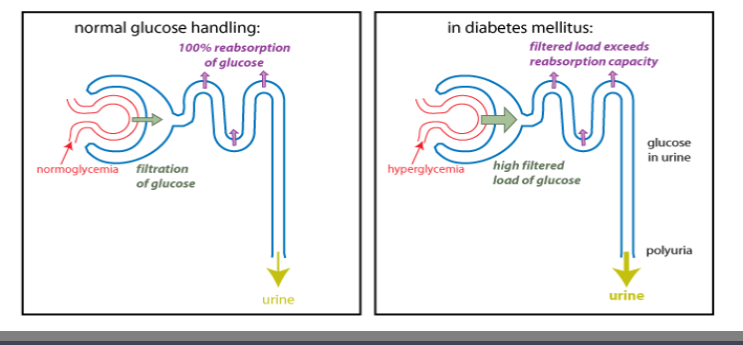 <ol><li><p>Frequent urination</p></li></ol><ul><li><p>abnormally high amounts of glucose in filtrate if nephron</p></li><li><p>consequently, more water is pulled via osmosis from renal capillaries into tubules</p></li></ul><ol start="2"><li><p>Increased thirst</p></li></ol><ul><li><p>due to need to replace excess water excreted</p></li><li><p>leads to increased water uptake</p></li></ul><ol start="3"><li><p>increased appetite</p></li></ol><ul><li><p>inability of insulin to help with glucose uptake into cells</p></li><li><p>leads to increased need to break down proteins and fats for energy, leading to further deficiencies that increase  hunger for these nutrients</p></li><li><p>end result is weight loss</p></li></ul><p></p>