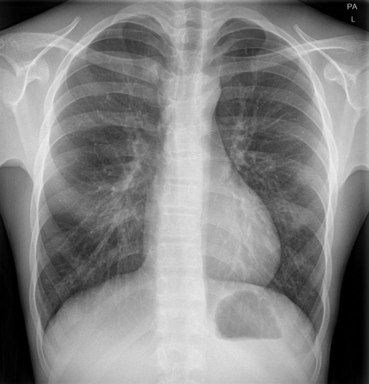 <p>age 15, gender M, pt is acutely breathless and might have a pneumothorax. CXR nl, no consolidation collapse, pneumothorax, or effusion. Nl mediastinal contour and pulmonary vasculature </p>