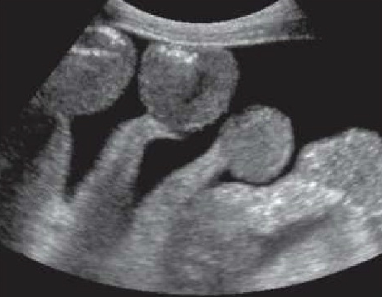 <p>bowel moving freely within it</p>