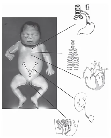 <ul><li><p>V: vertebral defects</p></li><li><p>A: anal atresia</p></li><li><p>C: cardiac anomalies</p></li><li><p>TE: tracheoesophageal fistula</p></li><li><p>R: renal anomalies</p></li><li><p>L: limb defects</p></li></ul><p></p>