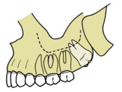 <p>ID the angulation classification of the impacted 3rd molar:</p>