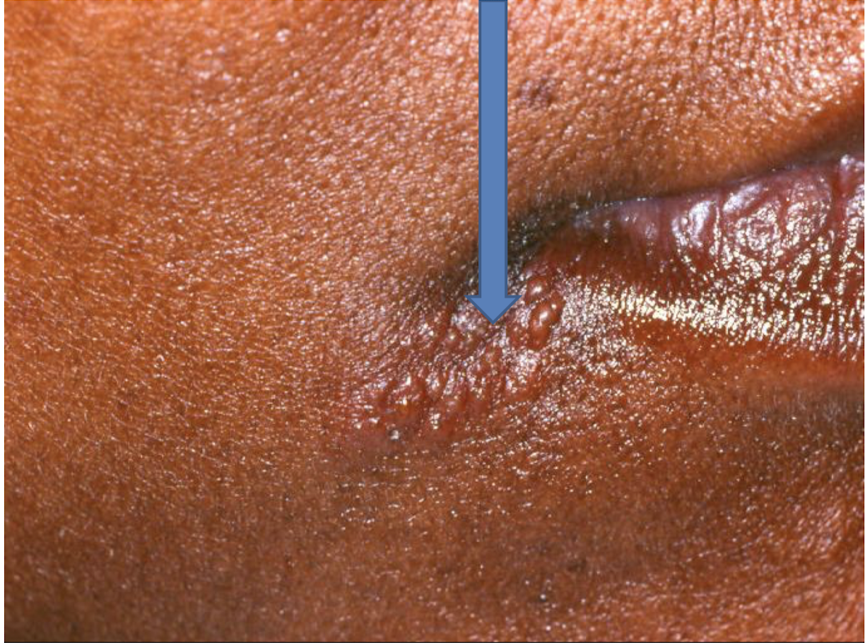 <p>what is this lesion</p>