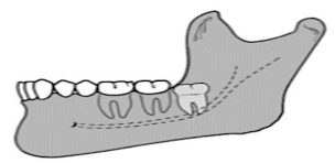 <p>the most difficult to remove</p><p>impacted tooth is <span style="color: red;">completely embedded in the bone</span> of the ramus of the mandible</p>