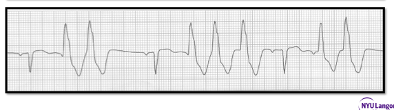 <p>Identify the above waveform:</p><p>a. Paired PVCs</p><p>b. Trigeminy</p><p>c. Bigeminy</p><p>d. PAC (premature atrial contraction)</p>