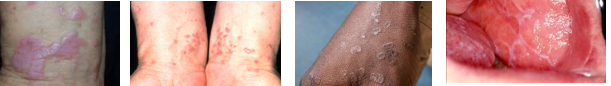 <p>Lichen Planus</p>