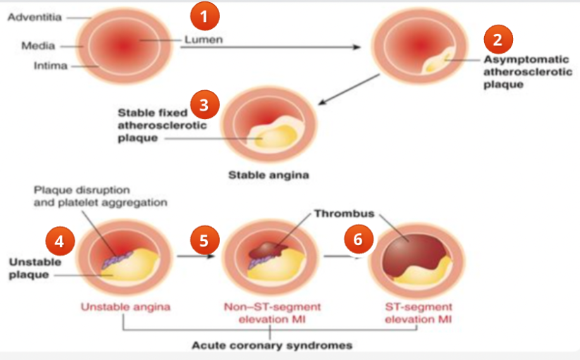 <ol><li><p>normal artery and vessel wall</p></li><li><p>asymptomatic</p></li><li><p>stable angina</p></li><li><p>unstable angina</p></li><li><p>thrombus</p></li><li><p>acute STEMI</p></li></ol><p></p>
