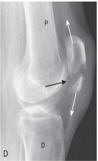 <p>fracture orientation</p>