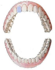 <p>maxillary right lateral incisor</p>