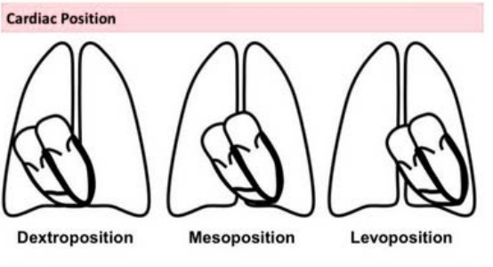 <p>Levocardia • Dextrocardia • Mesocardia</p>