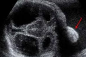 <p>What is being depicted in this image?</p><p>a. Macroglossia</p><p>b. Micrognathia</p><p>c. Hypertelorism</p><p>d. Proboscis</p>