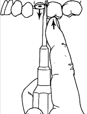 <p>apical; rotational</p>
