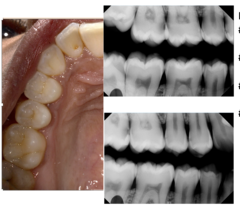 <p>What is the treatment for #2?</p><p>Findings:</p><p>- Visual: Occlusal-Initial</p><p>- Radiographic: M- Advanced</p>