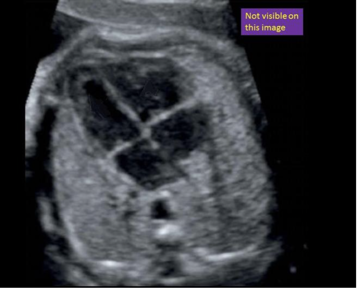 <p>Locate the ascending aorta. The structure may or may not be visible in the image</p>