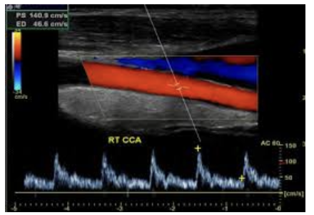 <ol><li><p>high systolic peak</p></li><li><p>normal continous flow. no reverse flow in early diastole </p></li></ol><p></p>