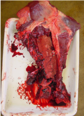 <p>Supraglenoid tubercle fracture</p>