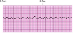 <p>ANS: B</p><p>On an electrocardiogram, ventricular fibrillation appears as a continuous, undulating pattern without</p><p>clear P, QRS, or T waves.</p><p>PTS: 1 DIF: Cognitive Level: Applying REF: p. 264</p><p>OBJ: Nursing Process Step: Assessment TOP: Cardiovascular</p><p>MSC: NCLEX: Physiologic Integrity</p>