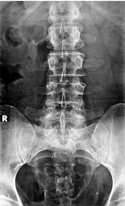 <p>Spina bifida of S1 with L5 spinous enlargement; pain on extension </p>