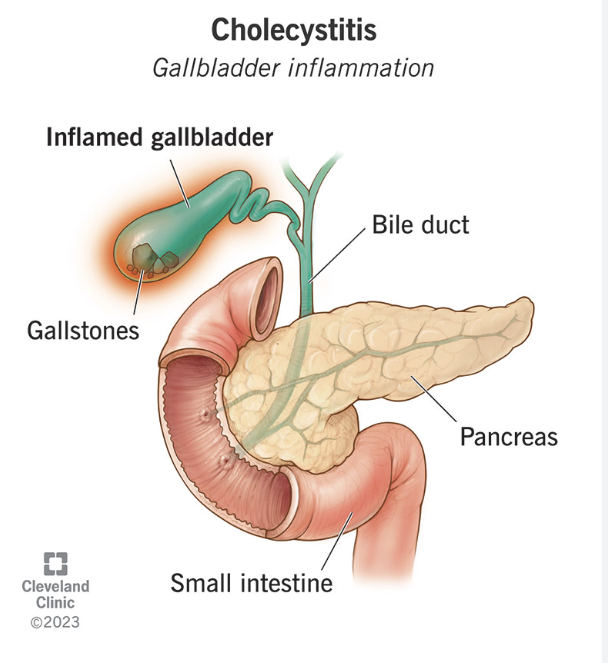<ul><li><p>Right upper quadrant pain</p></li><li><p>right shoulder pain</p></li><li><p>bloating/indigestion</p></li><li><p>pain after fatty foods</p></li></ul><p></p>
