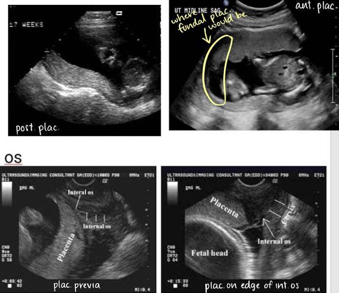 <ol><li><p><u>in uterus</u></p></li></ol><ul><li><p><span style="color: yellow;">anterior</span></p></li><li><p><span style="color: yellow;">posterior</span></p></li><li><p><span style="color: yellow;">fundal</span> (in uterine fundus)</p></li></ul><ol start="2"><li><p><u>in relationship to cervical os</u> </p></li></ol><ul><li><p><span style="color: yellow;">close to os</span></p></li><li><p><span style="color: yellow;">away from os</span></p></li><li><p><span style="color: yellow;">covering os</span></p><ul><li><p>if covering internal os, that is called <em>previa</em></p></li></ul></li></ul><p></p>