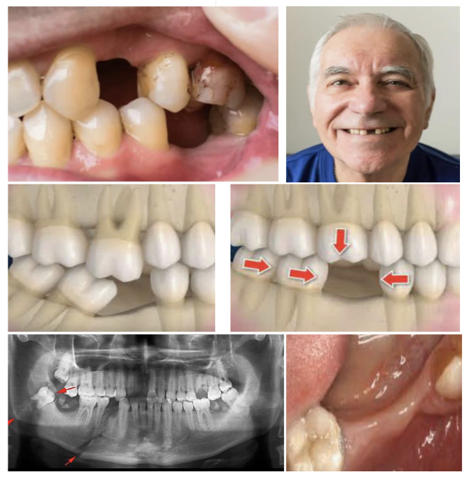 <p><span>Inclination of the adjacent teeth<br>Loss of proximal contact<br>Occlusal alterations:<br>prematurities and interferences<br>Alterations of the supporting tissue<br>Supraeruption of the antagonist tooth</span></p>