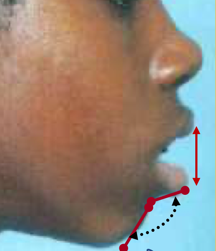 <p>an angular parameter formed by tangent of lower lip and soft tissue of chin </p><p>aka mentolabial angle or labiomental angle, is the soft tissue angle formed by the intersection of the lower lip and the chin</p>