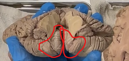 <p>The little bumps on the posterior lobes are the cerebellar tonsils. </p><ul><li><p><strong>Cerebellar</strong>: from Latin <em>cerebellum</em> = <strong>“little brain”</strong></p></li><li><p><strong>Tonsils</strong>: from Latin <em>tonsillae</em> = <strong>“almonds”</strong> (referring to their shape)</p></li></ul><p>Literal meaning:<br><strong>“almond-shaped parts of the little brain.”</strong></p><p>The <strong>cerebellar tonsils</strong> are <strong>two rounded lobules on the inferior (bottom) surface of the cerebellum</strong>, located <strong>just above the foramen magnum</strong>.</p><p>They are the <strong>lowest part of the cerebellum</strong>, sitting close to where the brain transitions into the spinal cord.</p>